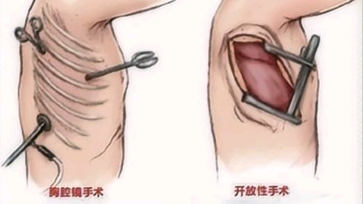 微至动态丨微至智能气腹机系统——食管癌手术的“微创利器”